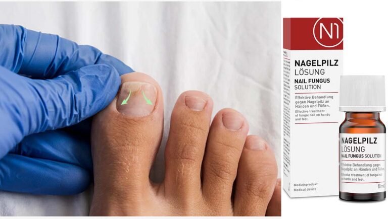 Was hilft gegen Nagelpilz? Die besten Mittel und Hausmittel im Uberblick Was hilft gegen Nagelpilz? Die besten Mittel und Hausmittel im Uberblick